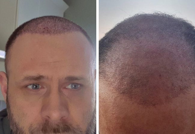Picture before after percutaneous hair transplantation 3700 grafts Michael Woulfe after 2 months