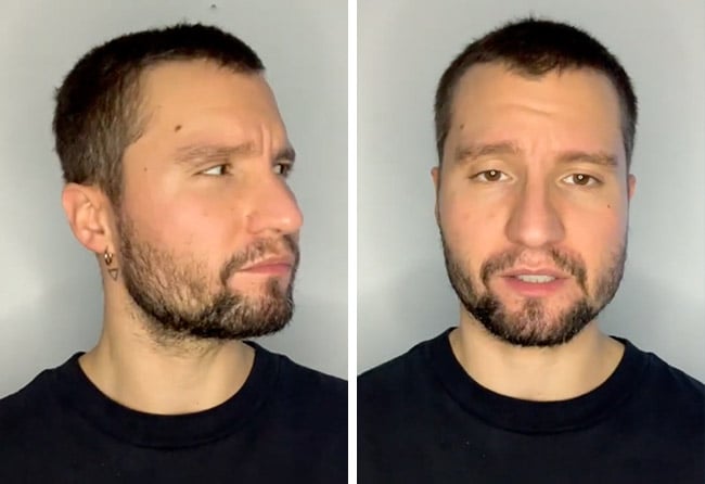 Picture before after sapphire beard transplantation 3500 grafts Dominik Schmitz after 2 months