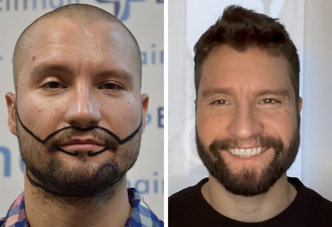 Picture before after sapphire beard transplantation 3500 grafts Dominik Schmitz