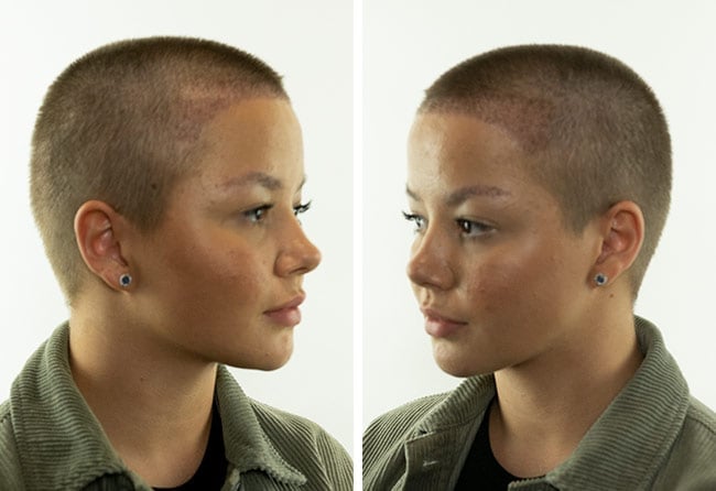 before after sapphire hair transplantation 2600 grafts Lilianna Steinhoeffel after 2 months
