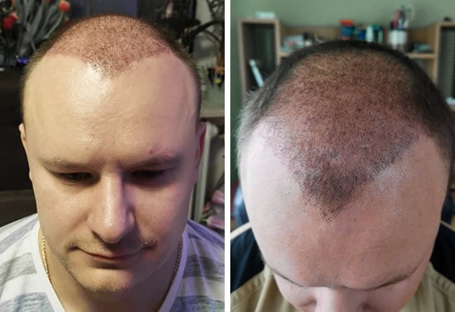 Picture before after sapphire hair transplantation 4200 grafts Sergej Weresomski after 2 months