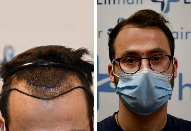Picture before dhi hair transplantation 3100 grafts Ricardo Beier