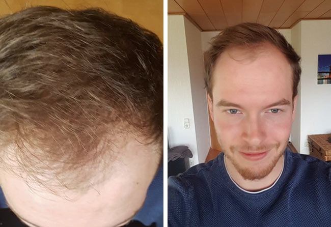 Picture before dhi hair transplantation 3500 grafts Lukas jaeger