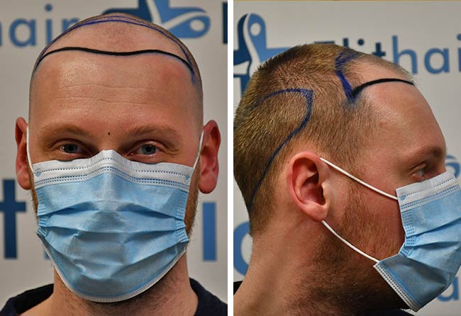 Picture before dhi hair transplantation 3950 grafts Oliver Dietrich