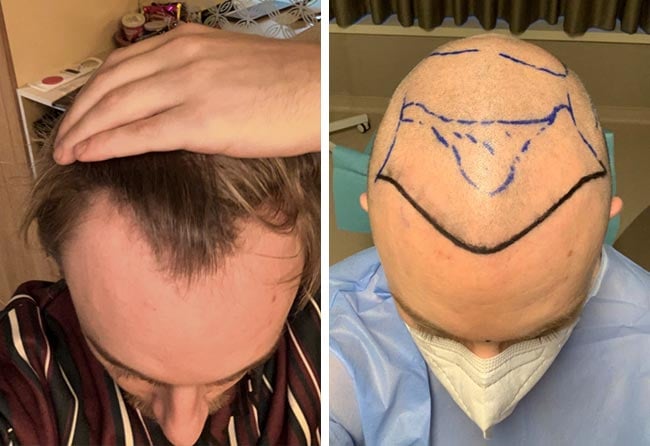 Picture before dhi hair transplantation 4200 grafts Marius Schmiddi
