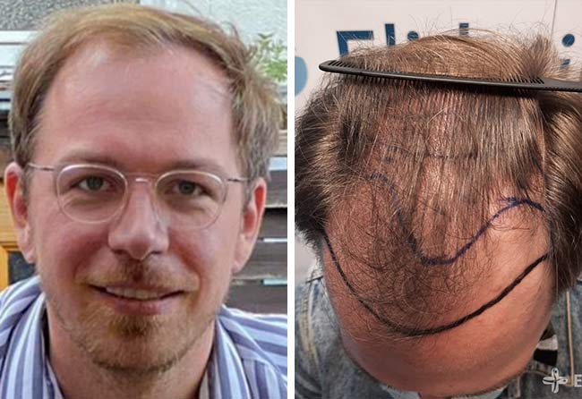Picture before dhi hair transplantation 4500 grafts tobias pluemacher