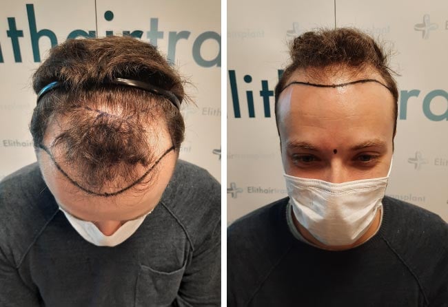 Picture before sapphire hair transplantation 4500 grafts Didac Scheffler