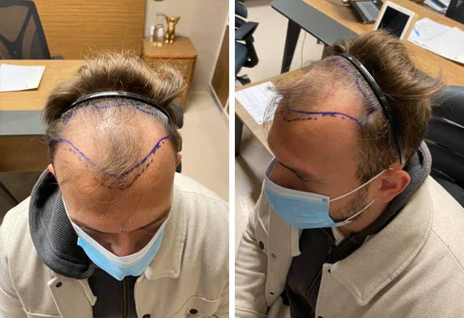 Picture before sapphire hair transplantation 4500 grafts Sefket Ahmetovic