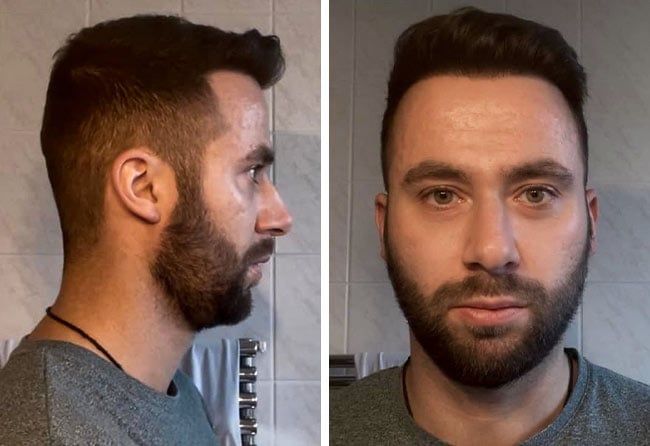 Picture result dhi hair transplantation 3100 grafts Ricardo Beier