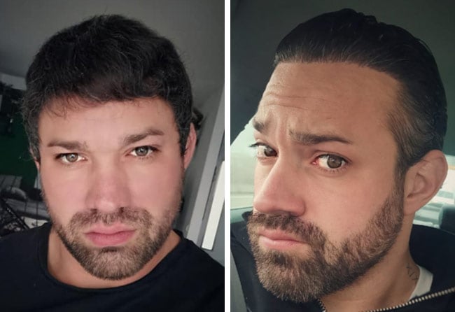 Picture result dhi hair transplantation 3700 grafts Manuel Anderhuber