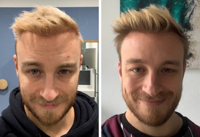 Picture result dhi hair transplantation 4200 grafts Marius Schmiddi