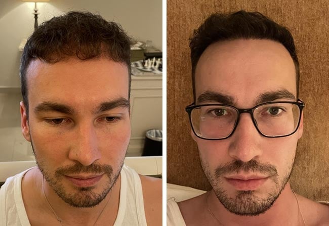Picture result dhi hair transplantation 4700 grafts Marcel Ploch