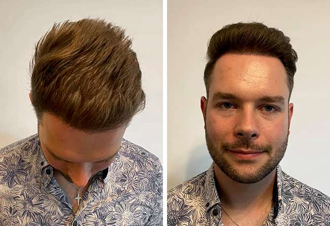 Picture result dhi hair transplantation 4700 grafts Michael Simma