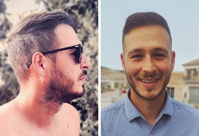 Picture result sapphire hair transplantation 4200 grafts Jorge Diaz