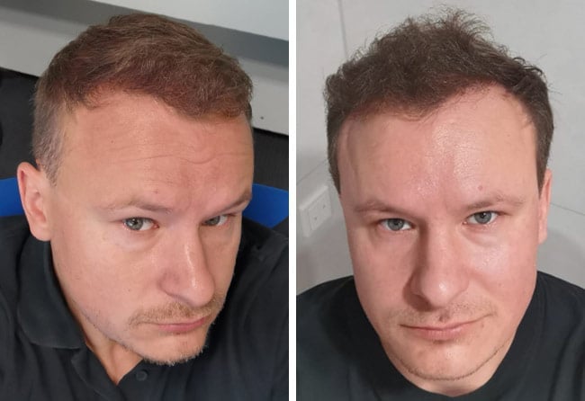 Picture result sapphire hair transplantation 4200 grafts Sergej Weresomski