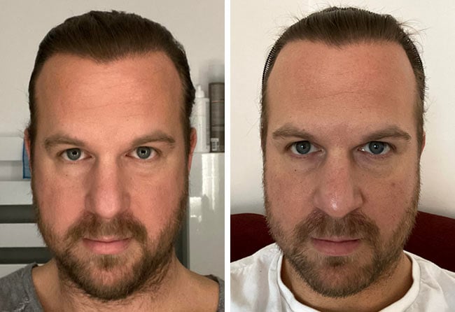 Picture result sdhi hair transplantation 2700 grafts Matthias Funk