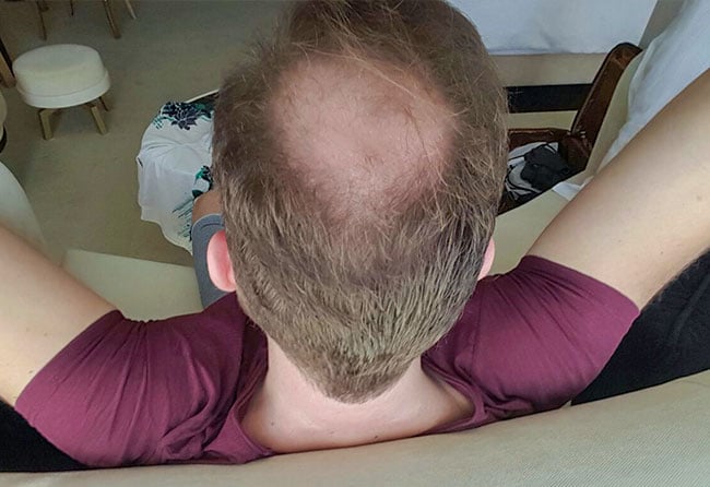 Stefan Heckmann before sapphire hair transplantation 3700 grafts