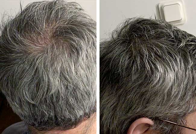 Ziad Ma after Sapphire hair transplantation 3000 grafts