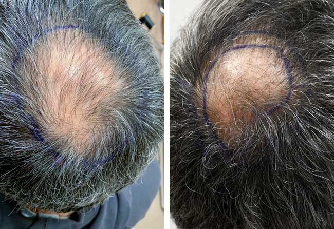 Ziad Ma before Sapphire hair transplantation 3000 grafts