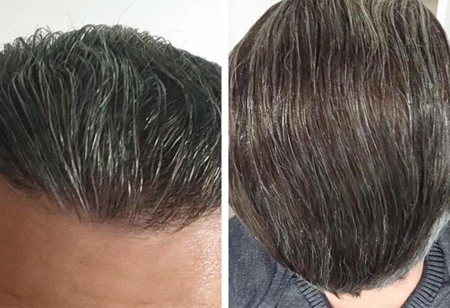 after sapphire hair transplantation crown 3100 grafts Daniel