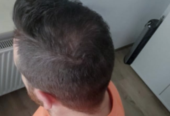 after sapphire hair transplantation crown 4000 grafts Tho Marky