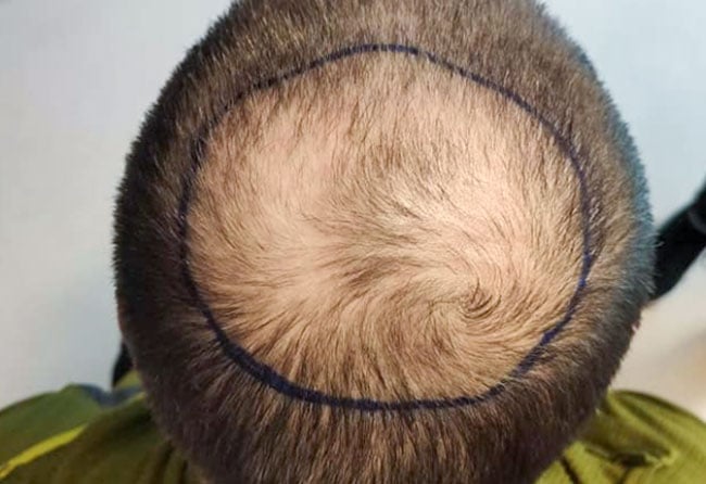before sapphire hair transplantation crown 4000 grafts Tho Marky