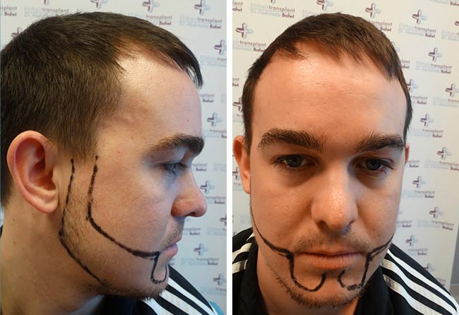 Before Sapphire Beard transplantation 4300 Grafts Oliver N