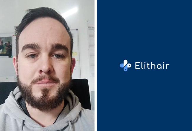 Picture of Oliver N's hair transplant result