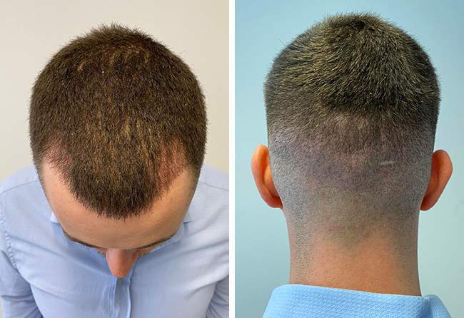 Picture after 4 weeks dhi hair transplantation 3140 grafts Patient Cilian White
