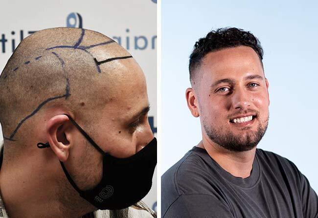 Picture before and after dhi hair transplant 4000 grafts Monier Achahbar