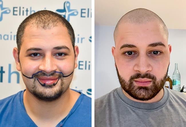 before and after sapphire beard transplant 3750 grafts mohammed e