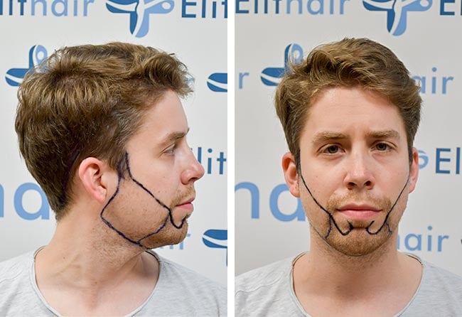 Before Sapphire beard transplant 3200 grafts Eike R