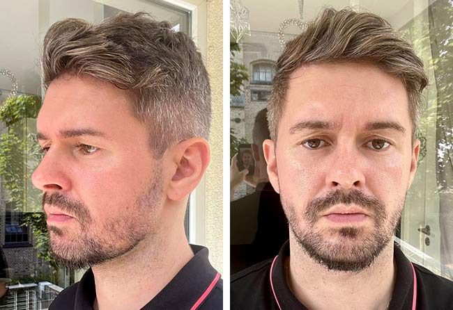 Before sapphire beard transplant 4250 Ismar S.