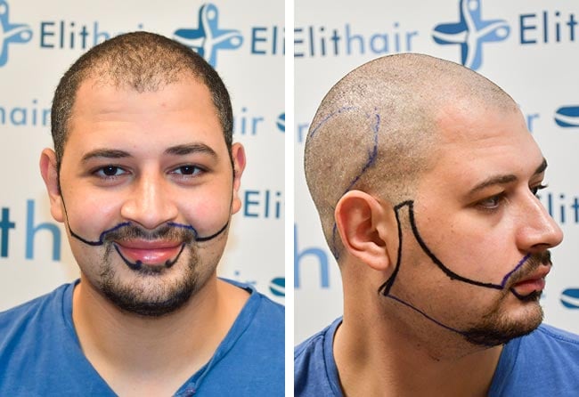 before sapphire beard transplant 3750 grafts mohammed e