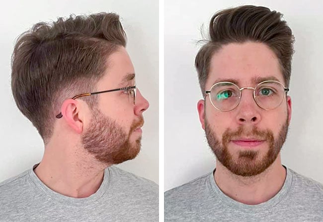 Result Sapphire beard transplant 3200 grafts Eike R