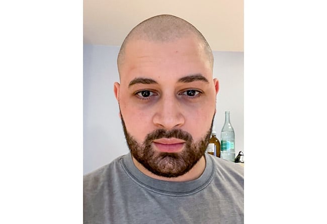 result sapphire beard transplant 3750 grafts mohammed e