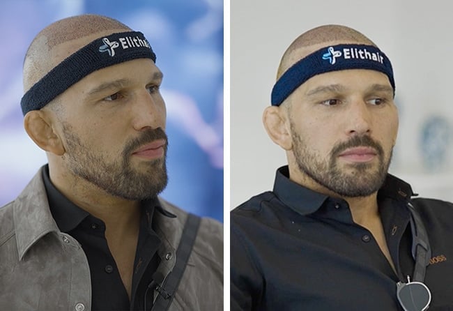picture of results day 1 dhi hair transplant max coga elithair turkey