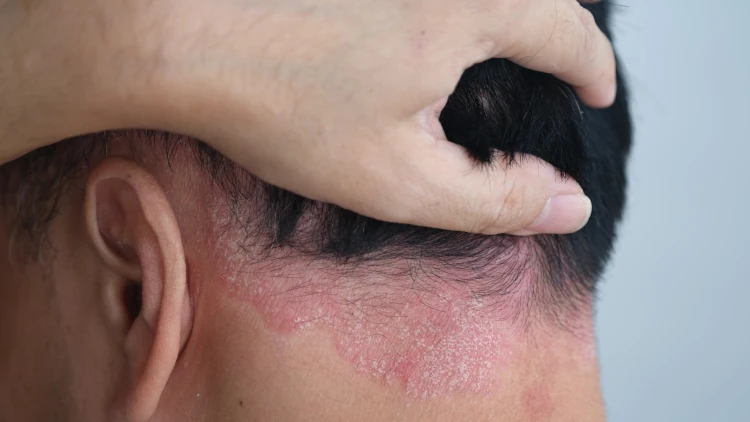 A close-up of the back of a man’s neck with psoriasis encroaching on his hairline.