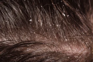 A close-up image of dandruff in a man’s hair.