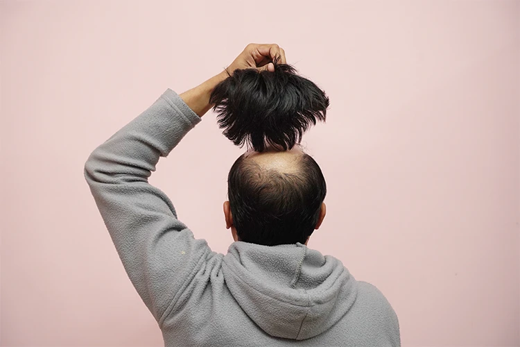 A man covers his bald spot with a toupee.
