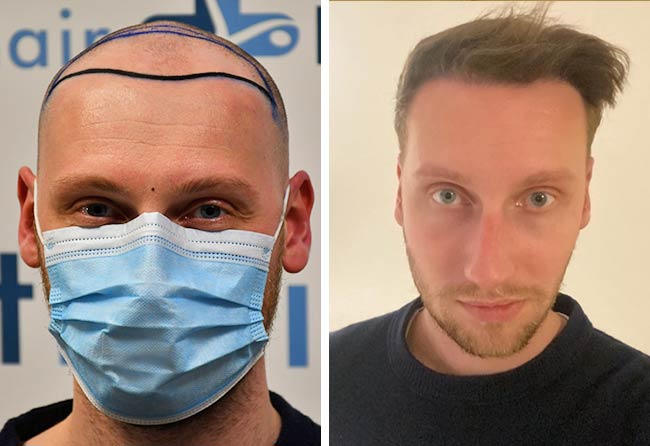 Hair transplant before and after result at Elithair &ndash; Oliver Dietrich, 3,950 grafts DHI