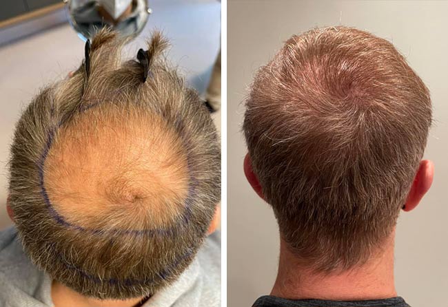 Crown hair transplant before and after &ndash; Raffaele L., 4,750 grafts DHI