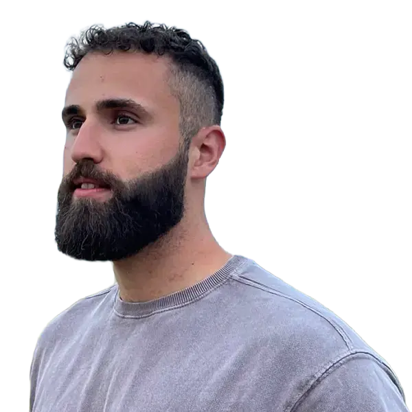 Beard transplant result of a male patient showing fuller, well-defined beard growth with natural density after treatment