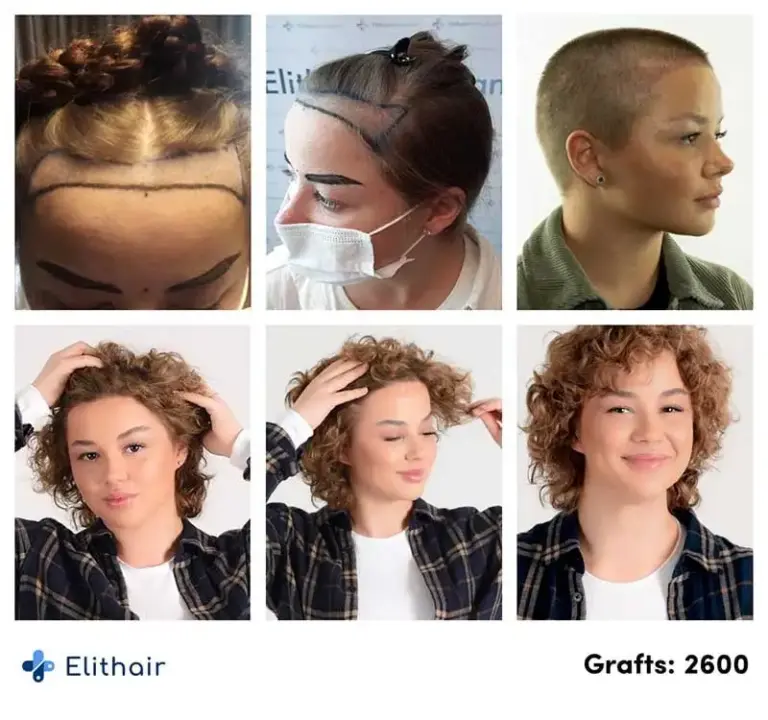 Thumbnail picture before and after the hair transplant for woman with 2600 grafts of Lilianna, an Elithair patient