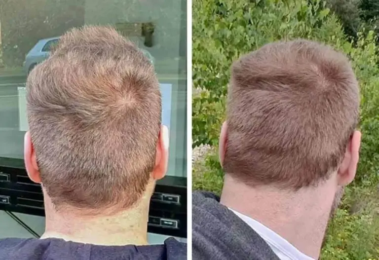 Donor area after hair transplant shown by an Elithair patient