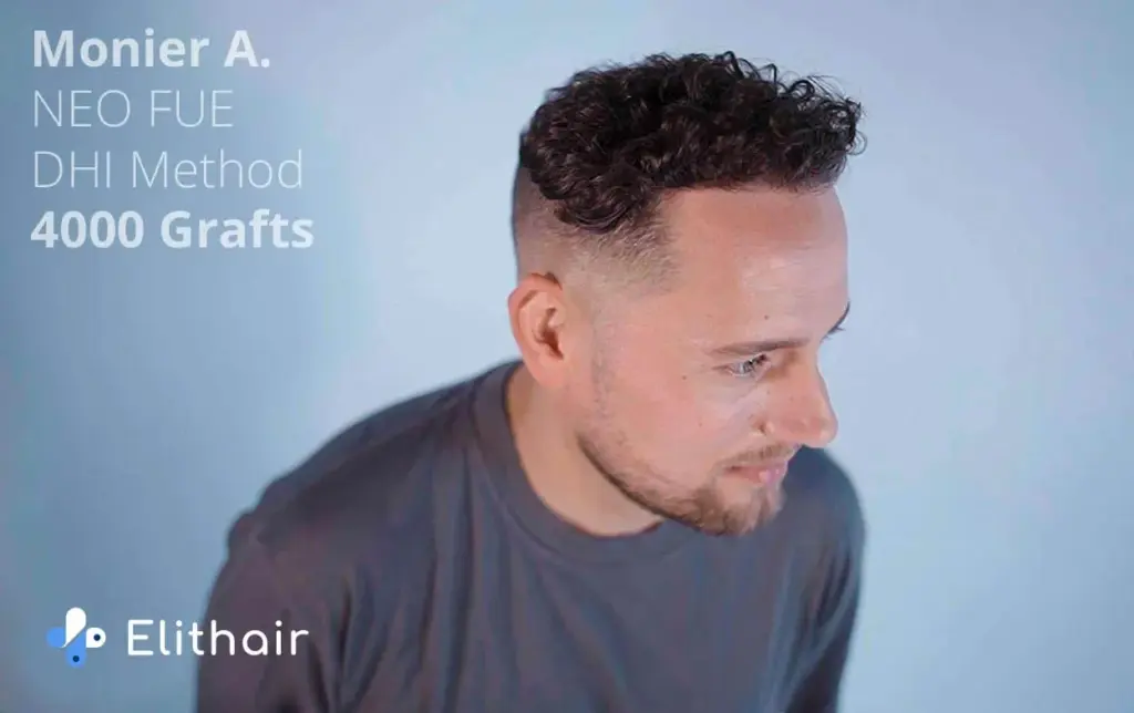 Patient Monier who had a positive hair transplant experience with Elithair showing his full hair