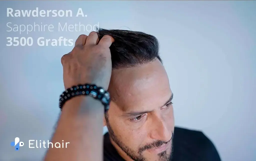 Patient Rawderson who had a positive hair transplant experience with Elithair showing his result
