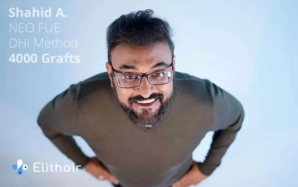 Patient Shahid who had a positive hair transplant experience with Elithair showing his result