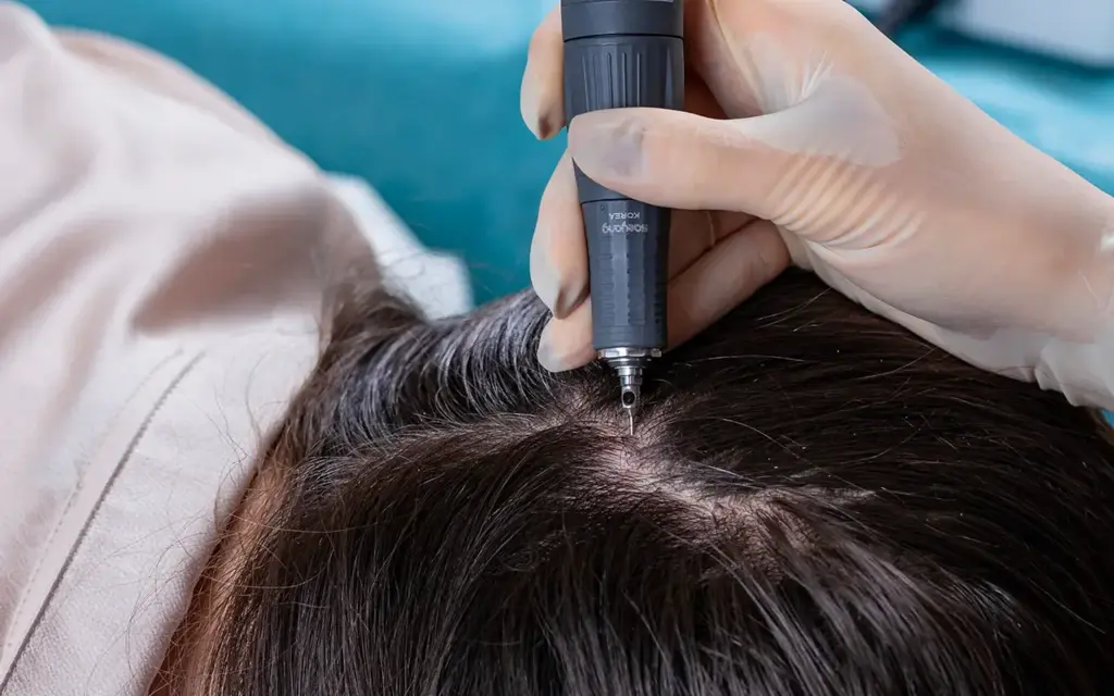FUE hair transplant technique showing individual follicle extraction and implantation for natural hair restoration results