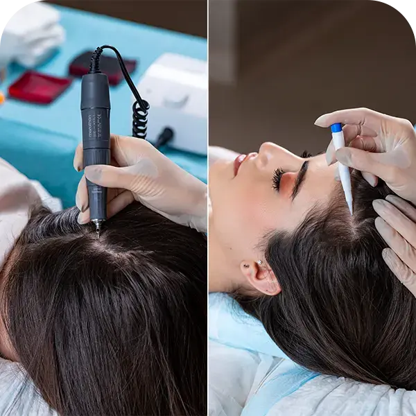 Comparison of FUE and DHI hair transplant techniques showing differences in extraction and implantation methods for natural results